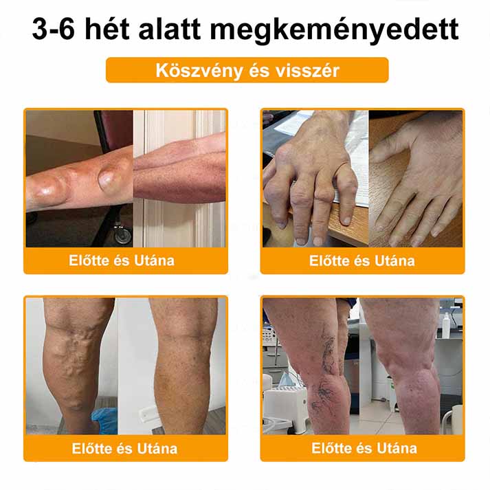 ✨ARTART™ Méhméreg Fájdalomcsillapító Csontregeneráló Krém (Kifejezetten ízületi fájdalmakkal küzdő betegek számára tervezve, szakértők ajánlásával)